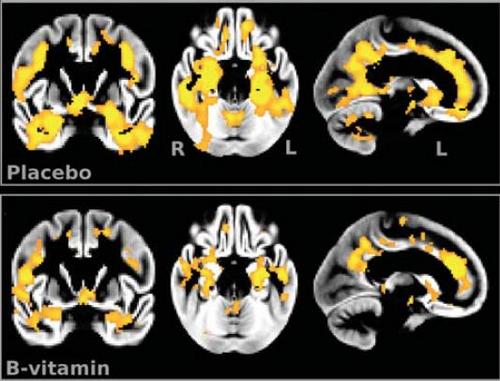 Brain Vitamins: Essential for a Healthy Brain